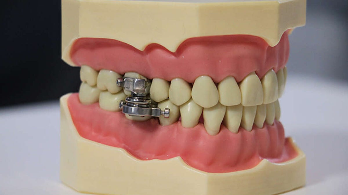 Este dispositivo para adelgazar evita que la boca se abra