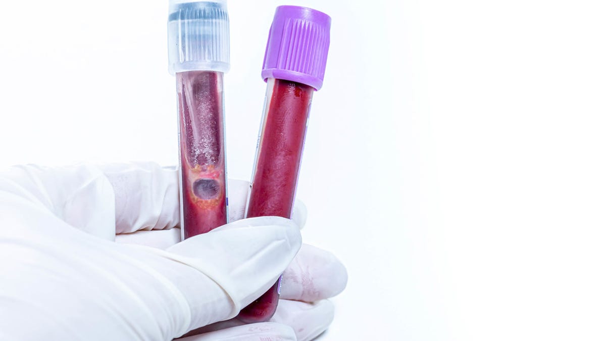 Una prueba de sangre puede detectar tumores temprano
