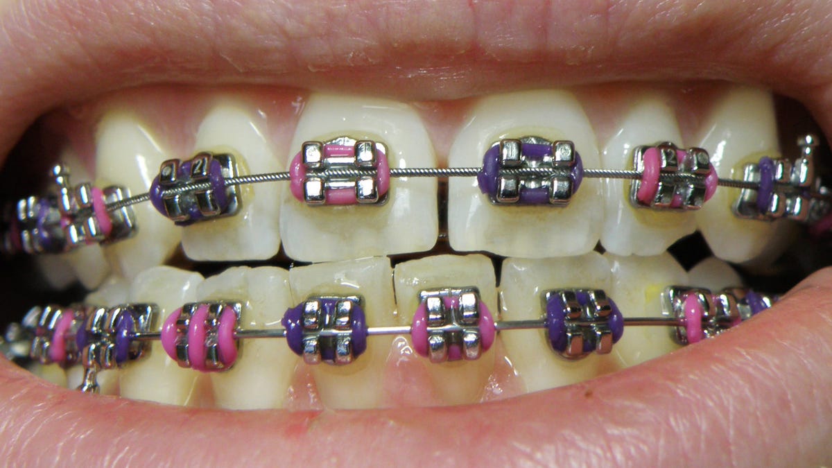 La razón por la que los aparatos para los dientes son de metal