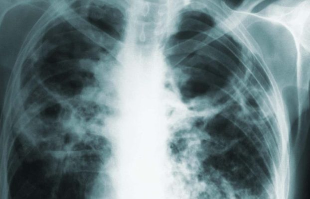 ¿Cárcel al negarse a tratamiento contra la tuberculosis?