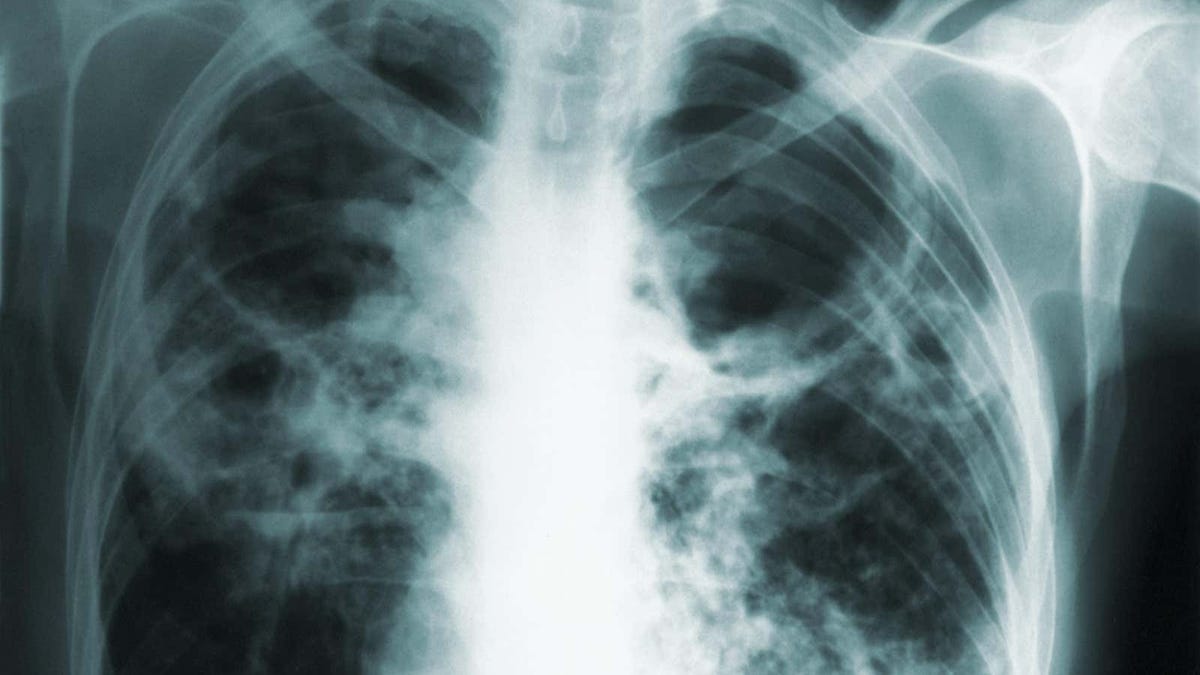 ¿Cárcel al negarse a tratamiento contra la tuberculosis?