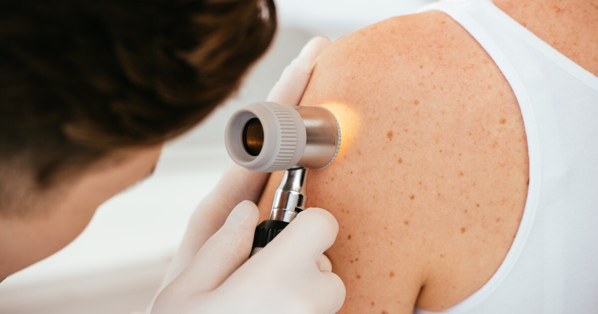 La terapia con ARNm contra el cáncer de piel reduce a la mitad el riesgo de muerte en un ensayo clínico