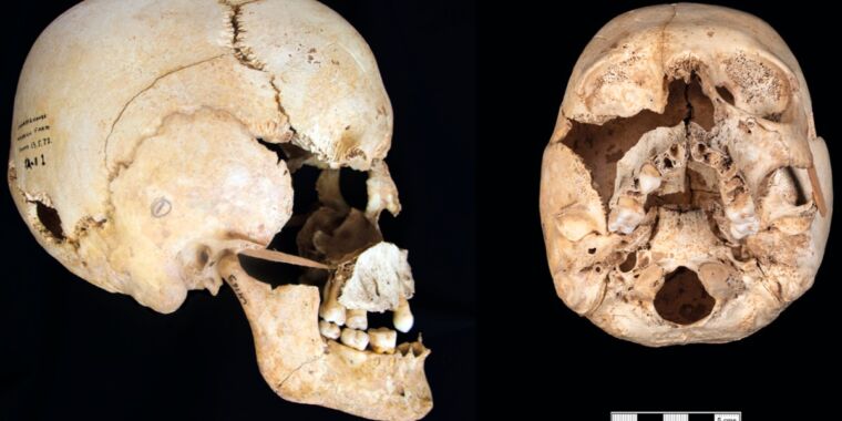 Los científicos identifican a la primera persona prehistórica conocida con síndrome de Turner