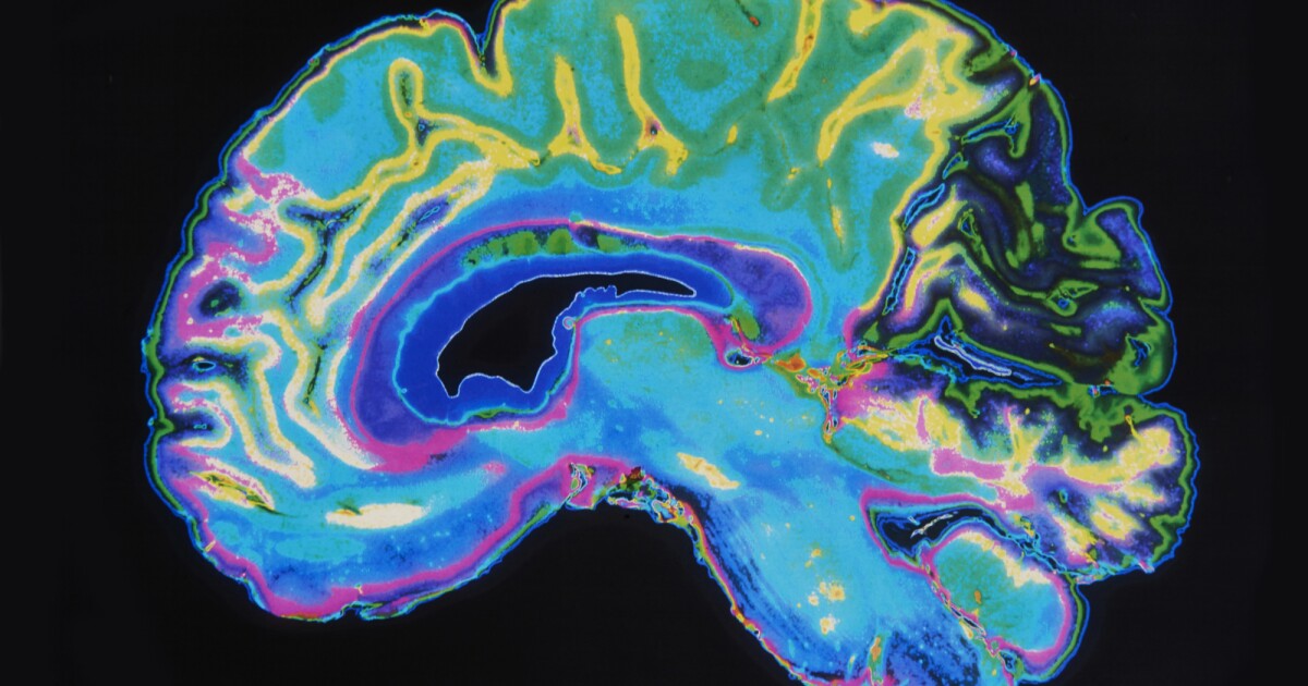 La ‘firma’ de resonancia magnética puede revelar demencia entre 5 y 10 años antes de que aparezcan los síntomas