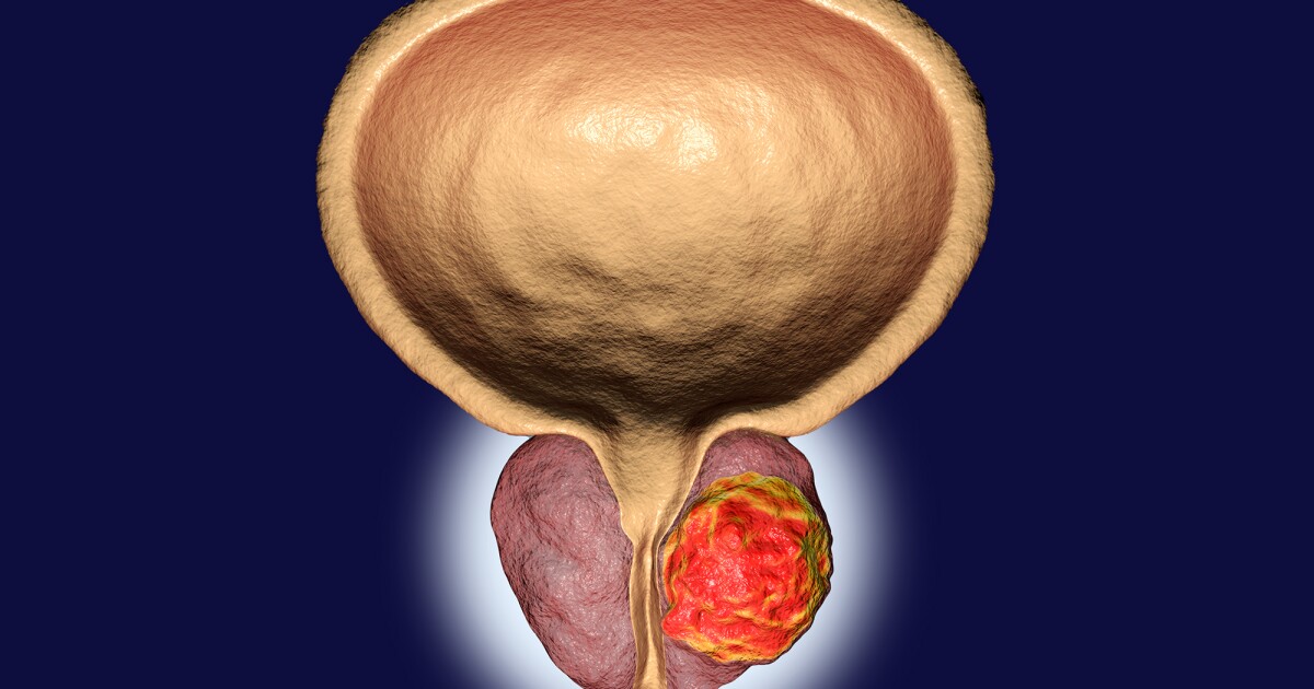 El extracto de aceite de sándalo es un tratamiento eficaz contra el cáncer de próstata en ratones
