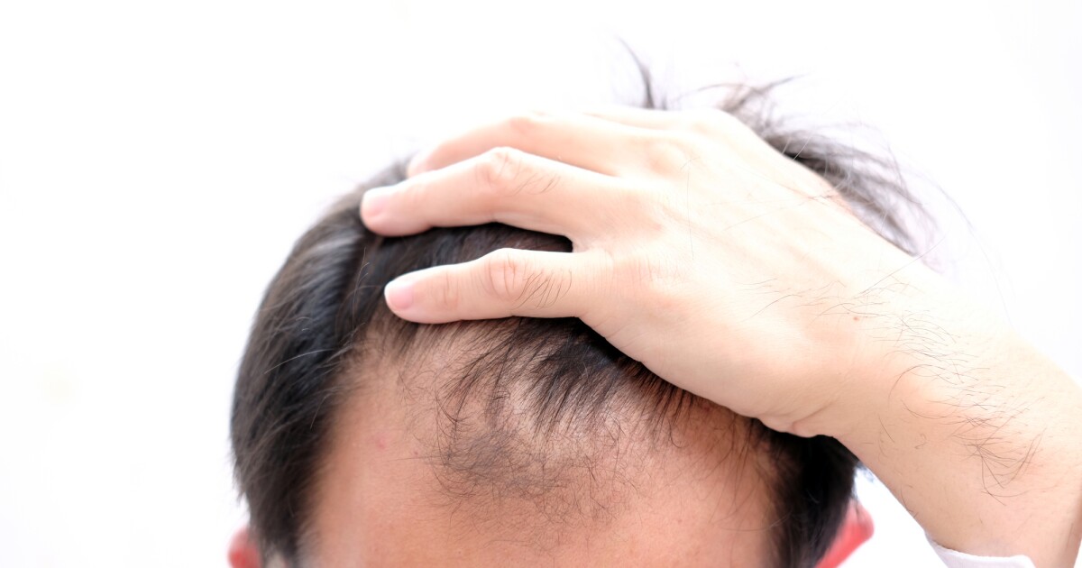 Avance contra la caída del cabello encontrado en microesferas de queratina