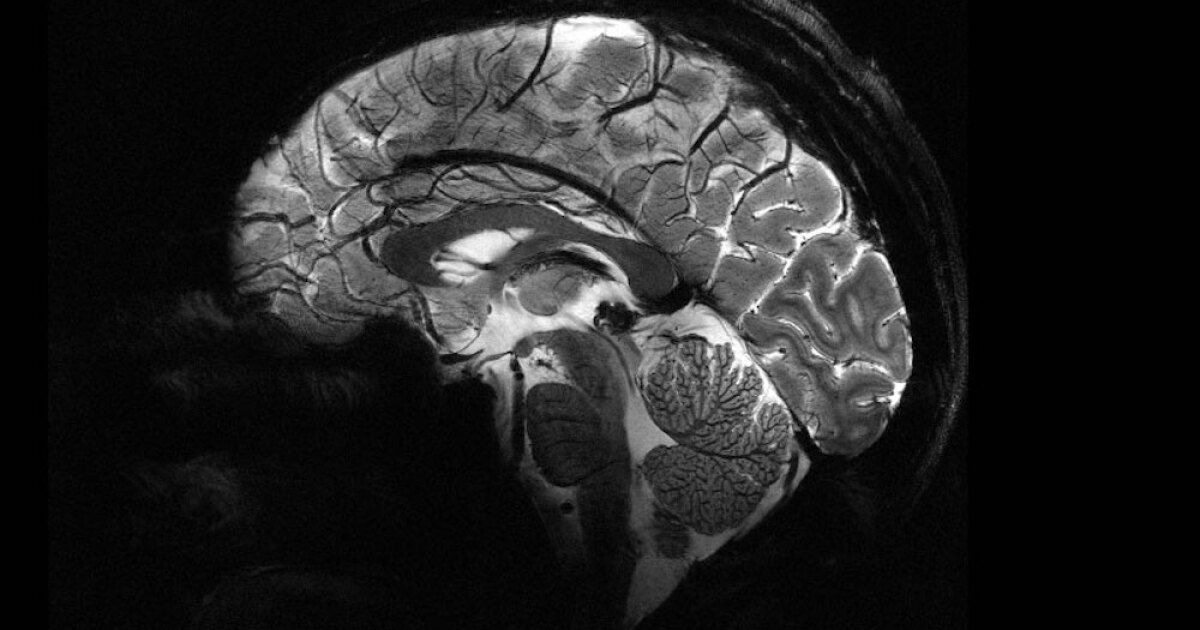 La máquina de resonancia magnética más potente del mundo captura los primeros escáneres cerebrales impresionantes