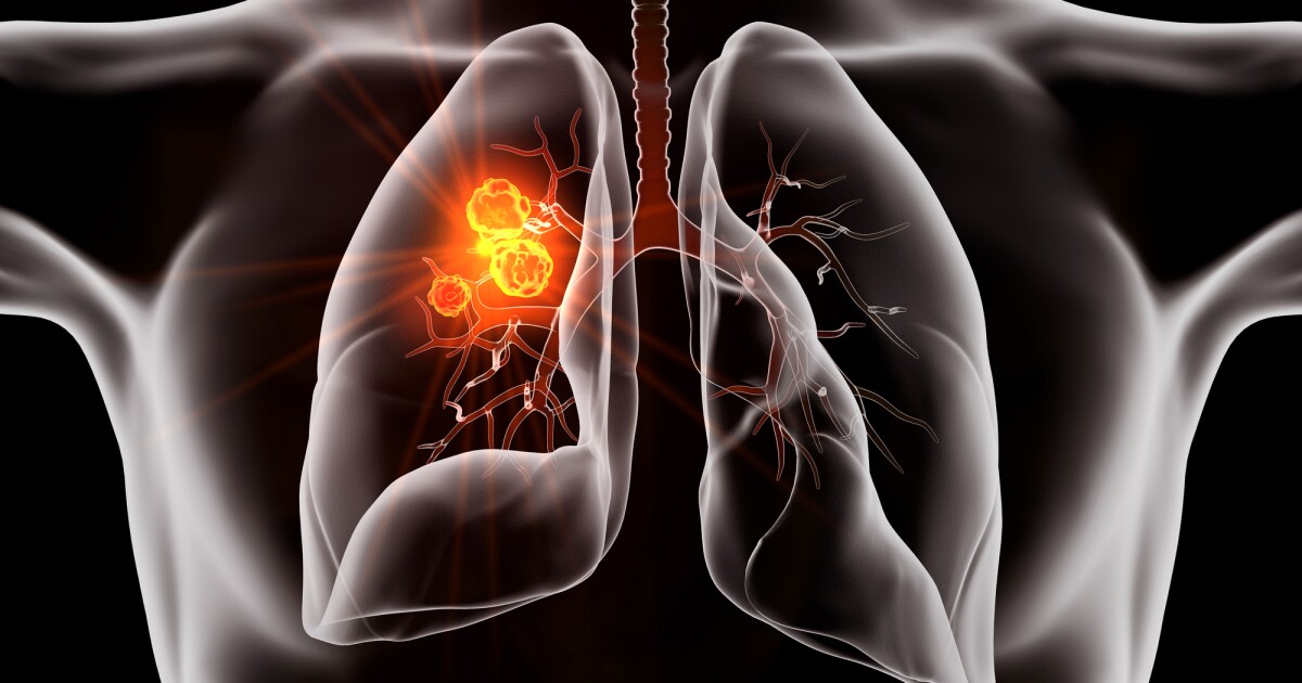 Una nueva píldora contra el cáncer de pulmón produce resultados “sin precedentes” en un ensayo en humanos