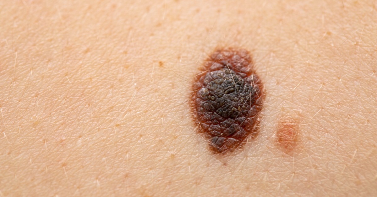 El riesgo de recurrencia del melanoma se reduce en un 49% gracias a la nueva combinación de vacuna y fármaco existente