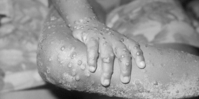 Nuevo brote de mpox genera alarma; la OMS estudia declarar emergencia internacional