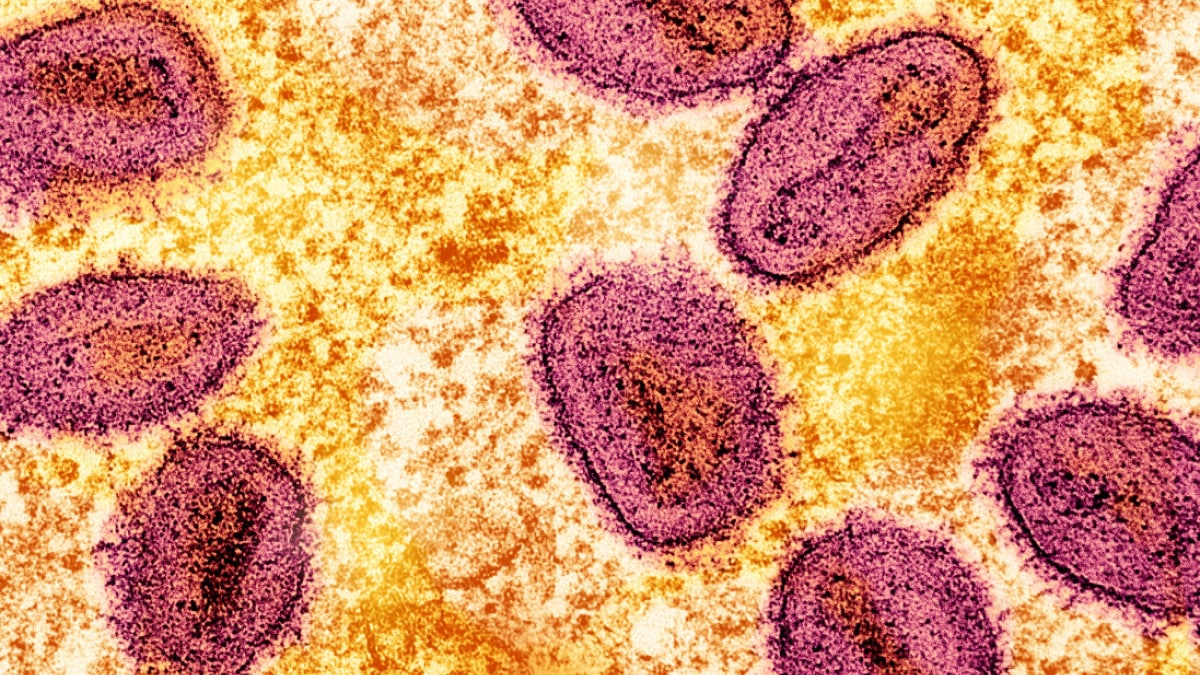 Detectada una nueva cepa de Mpox en Suecia, el primer caso fuera de África