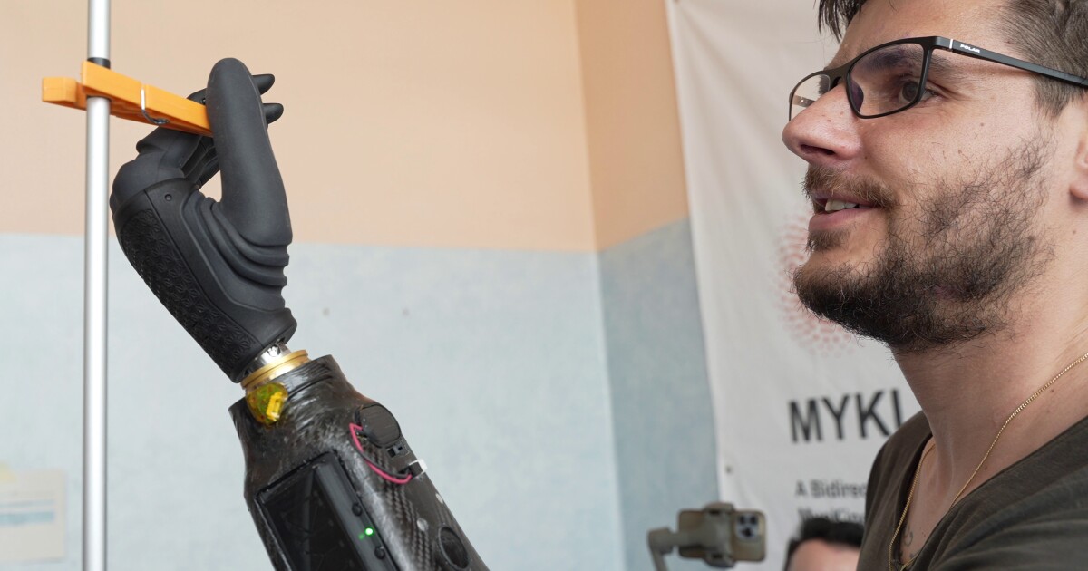 Los pequeños imanes implantados permiten un control mejor y más sencillo de la mano protésica