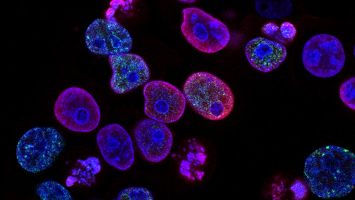 La concienciación sobre el cáncer de páncreas es baja entre los adultos menores de 50 años, a pesar del aumento de casos