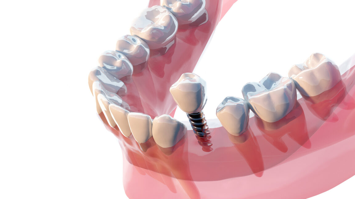 Una nueva estafa dental consiste en extraer dientes sanos para venderte dientes falsos y caros.