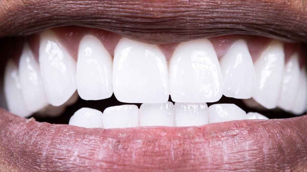 ¿Qué es un puente de cálculo? Y cómo prevenir uno en los dientes