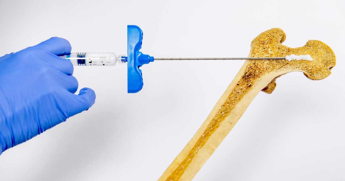 El gel de «hueso inyectable» puede ser un tratamiento radicalmente mejor para la osteoporosis