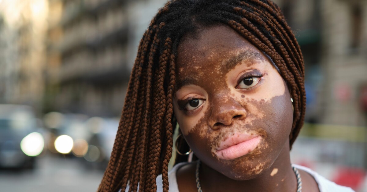 Las bacterias intestinales pueden ser la clave para un tratamiento de vitiligo mucho más efectivo