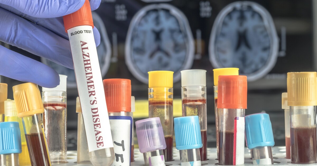 La FDA aprueba el primer análisis de sangre para la detección temprana de Alzheimer